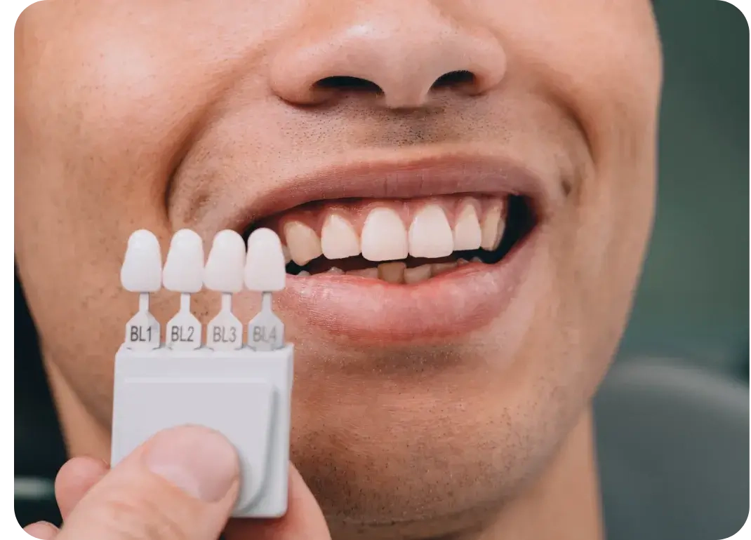 Branqueamento Dentário