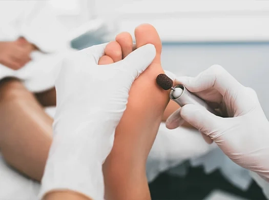 Calos e calosidades (hiperqueratoses)