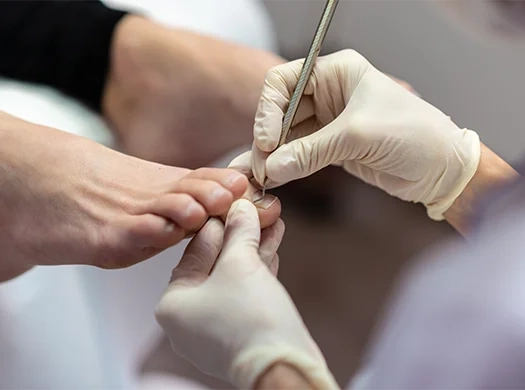 Unhas encravadas (com ou sem infeção)