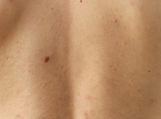 Doenças de pele autoimunes