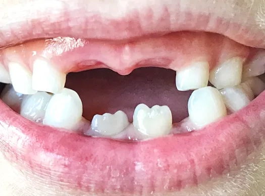 Traumatismos dentários