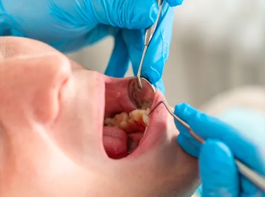 Extrações dentárias